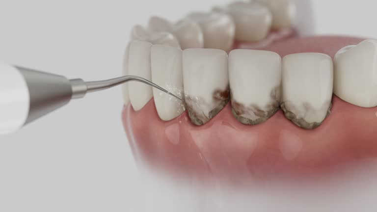 Trusted Wisdom Tooth Removal service in Lyman, SC - Dentist Open Now